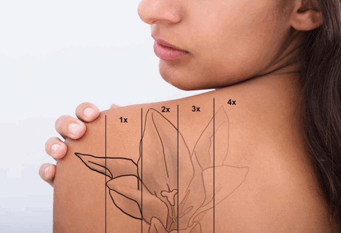 Top 5 Lifestyle Hacks to Speed Up Tattoo Removal